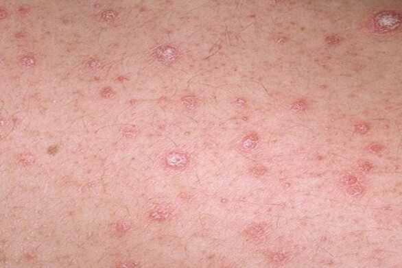 psoriasis-sympt-mes-chez-les-adultes-et-les-enfants-comment-il